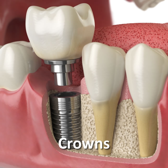 Crowns | Dental Restorative | Santa Rosa