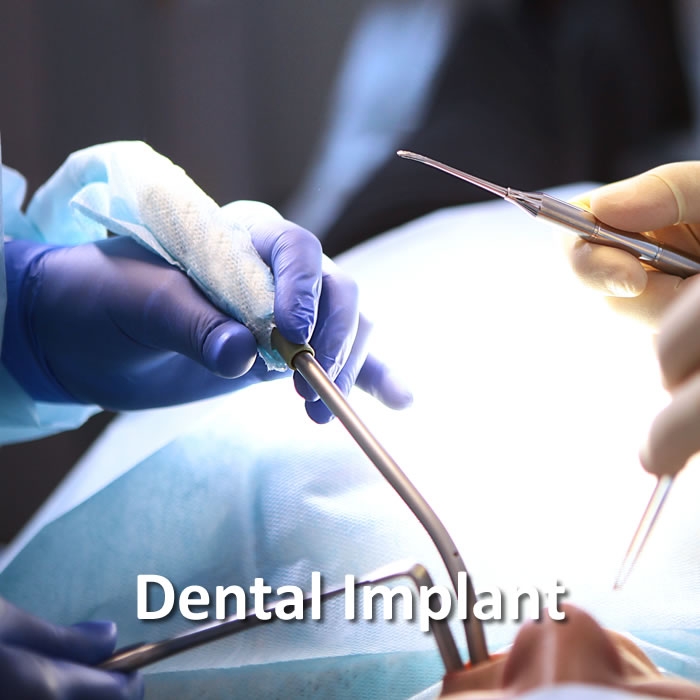 Implants | Dental Restorative | Santa Rosa